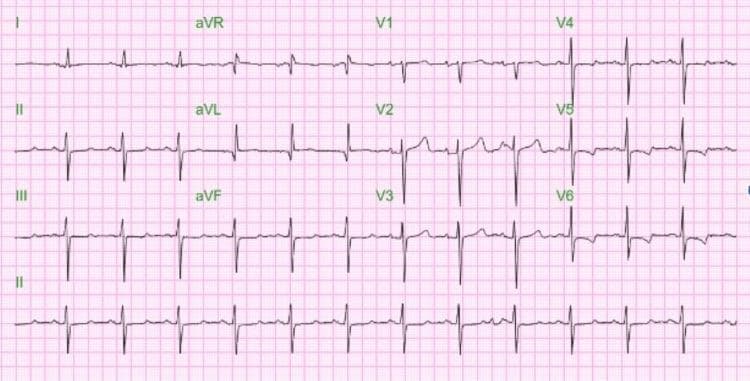 This diagnostic image is a 12-lead electrocardiogram (ECG/EKG) displayed on a standard pink grid background. The tracing shows a regular rhythm with a heart rate of approximately 77 beats per minute. Key visual findings include narrow QRS complexes across both limb leads (I, II, III, aVR, aVL, aVF) and precordial leads (V1-V6). In the limb leads, distinct Q, R, and S waves are visible with no significant slurring or notching. T waves are upright in leads I, II, aVF, and V4-V6, while inverted in aVR. Precordial leads show normal R-wave progression from V1 to V6. The ECG represents a post-intervention state following the placement of a transvenous pacemaker (TVP) for a previous complete heart block and hyperkalemia. The current tracing demonstrates resolution of previous bradycardia and successful stabilization of the cardiac rhythm with improved QRS and T wave morphology.
