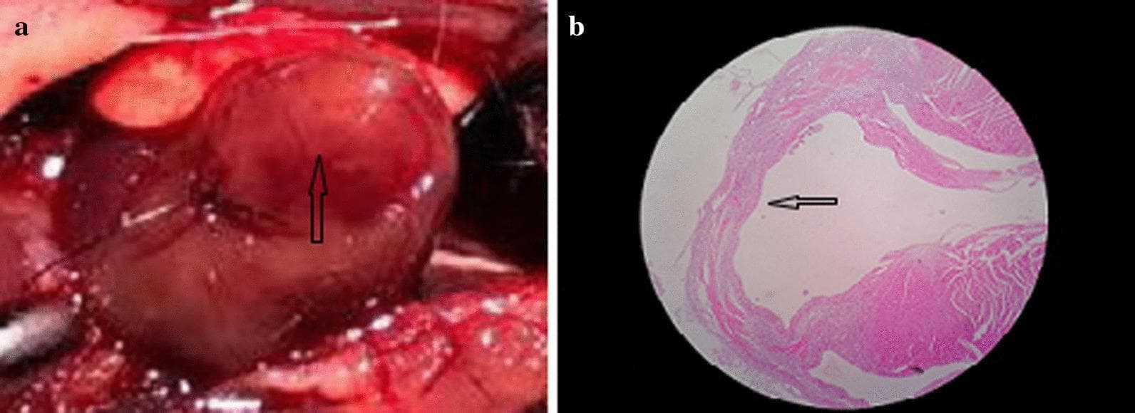 This composite educational material presents the macroscopic and microscopic features of myocardial infarction following surgical ligation of the left anterior descending (LAD) artery in a mouse model.
Panel A is a clinical photograph (gross specimen) of the heart during a surgical procedure. It demonstrates an area of myocardial whitening (pallor) distal to the ligation line, indicated by a black arrow. This visual change represents acute ischemia and initial tissue necrosis.
Panel B shows a diagnostic histopathology image of the heart stained with Hematoxylin-Eosin (HE). The cross-section reveals structural changes in the ventricular wall. A black arrow points to an area of significant myocardium thinning, a hallmark of remodeling and tissue loss following infarction. The pink-stained eosinophilic regions highlight the remaining muscular architecture, while the structural thinning indicates the progression of the injury.
Together, these images illustrate the correlation between macroscopic ischemic signs (whitening) and microscopic structural pathology (wall thinning) in the context of cardiovascular research and ischemic heart disease models.
