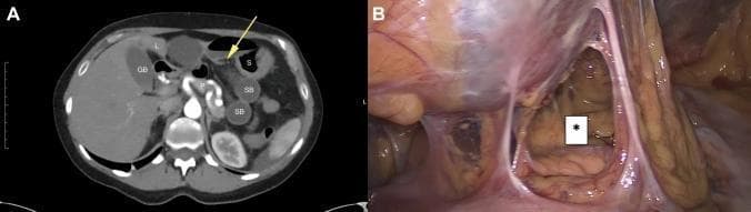 This figure presents diagnostic and intraoperative views of an isolated spontaneous lesser omental hernia. Panel A is an axial contrast-enhanced CT scan of the upper abdomen showing a 'closed-loop' internal hernia. Abnormally positioned, dilated small-bowel loops (SB) are incarcerated within the lesser omental sac (omental bursa), situated between the liver (L), stomach (S), and pancreas (P). A yellow arrow identifies the gastrohepatic ligament, indicating the site of herniation into the lesser sac. Panel B is a corresponding intraoperative laparoscopic photograph following the reduction of the herniated bowel. An asterisk (*) marks the defect in the lesser omentum, characterized by a clear opening with defined edges formed by thin, translucent mesenteric membranes. This illustrates a rare form of internal hernia where abdominal contents prolapse through the lesser omentum, often leading to acute small bowel obstruction (ileus). The images demonstrate the correlation between preoperative cross-sectional imaging and surgical findings in mechanical bowel obstruction.