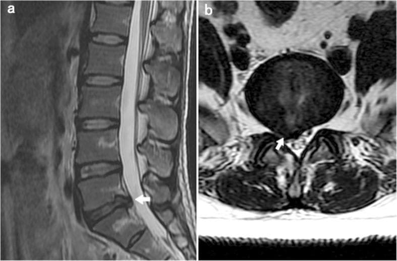 This diagnostic image consists of two T2-weighted magnetic resonance imaging (MRI) scans of the lumbar spine, demonstrating a lumbar disc herniation. Panel (a) is a sagittal view showing the lumbosacral spine. The intervertebral discs from L1 to L4 appear normal with high central signal intensity, while the L5-S1 disc exhibits decreased signal intensity (indicating dehydration/degeneration) and a posterior protrusion into the spinal canal (marked with a white arrow). Panel (b) provides an axial view at the L5-S1 level. It clearly illustrates a focal posterior disc herniation that is displacing and compressing the adjacent right-sided nerve root within the lateral recess. The thecal sac and posterior elements, including the lamina and facet joints, are visible. These findings are clinically relevant for diagnosing radiculopathy and sciatica. The image serves as an educational tool for identifying degenerative disc disease and neurovascular impingement in the lumbar region.