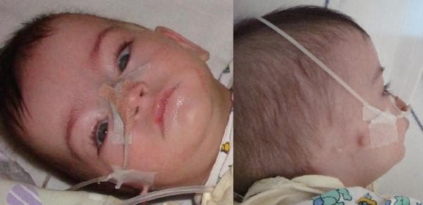 This clinical photograph displays a 5-month-old infant in two views (frontal and profile) illustrating dysmorphic facial features associated with a complex chromosome 5 rearrangement (Cri-du-Chat syndrome variant). In the frontal view, there is evidence of hypertelorism (increased interpupillary distance), convergent strabismus, and notably long eyelashes. The skull shape exhibits dolichocephaly (elongation) and relative macrocephaly. The lower face shows microretrognathia, characterized by a small, receding mandible. The lateral profile photograph highlights significant auricular abnormalities on the right side, including ear agenesis (anotia) with two visible preauricular skin tags. Medical equipment, including a nasogastric tube and adhesive dressings on the nose and cheek, is present, indicating ongoing clinical care for feeding difficulties or airway management. These visible phenotypic markers are critical for the clinical diagnosis of genetic syndromes involving the 5p chromosomal region.