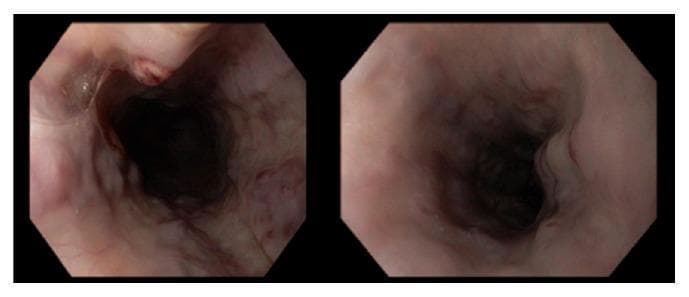 This diagnostic endoscopic image (esophagogastroduodenoscopy) provides a view of the esophagus, revealing extensive esophageal varices. The visual field shows a distended esophageal lumen with numerous large, tortuous, and dilated submucosal veins appearing as bluish-purple bulging columns along the longitudinal axis of the esophageal wall. The mucosal lining over these varices exhibits color variations, ranging from normal pink to focal areas of deep red. Critical visual markers of high bleeding risk are present, including 'red wale signs' (longitudinal red streaks resembling whip marks) and a 'nipple sign,' which indicates a site of recent or impending hemorrhage. These findings are characteristic of 'downhill' esophageal varices, often associated with superior vena cava (SVC) syndrome or portal hypertension. The image demonstrates severe vascular congestion and structural distortion of the esophageal mucosa, serving as a key educational example for identifying high-risk variceal stigmata during upper gastrointestinal endoscopy.