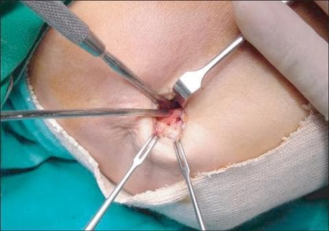 This clinical photograph captures an intraoperative view of a surgical procedure for lateral epicondylitis (tennis elbow). The image shows the lateral aspect of the elbow under local anesthesia with a 1.5 cm skin incision. Following the detachment and excision of the degenerative origin of the extensor carpi radialis brevis (ECRB) tendon, the cortical bone of the lateral epicondyle is exposed. Visible within the center of the surgical field are multiple small drill holes made using a microfracture technique. These holes demonstrate active punctate bleeding, an intentional surgical step designed to facilitate blood flow and promote the recruitment of mesenchymal stem cells to enhance fibrous tissue regeneration at the bony bed. Four metallic surgical instruments, including small retractors and a textured-handle probe, are used to provide visualization of the site. This image serves as a clinical demonstration of the Nirschl-type surgical approach for chronic tendinopathy, highlighting the transition from debridement to marrow stimulation.