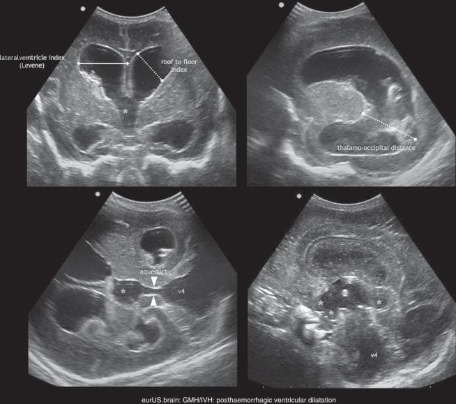 This composite of four neonatal cranial ultrasound images demonstrates post-hemorrhagic ventricular dilatation (PHVD) following germinal matrix-intraventricular hemorrhage (GMH/IVH). The top left coronal scan shows significantly enlarged lateral ventricles with labeled measurements for the 'Lateralventricle index (Levene)' and the 'roof to floor index.' The top right parasagittal scan highlights a dilated lateral ventricle and occipital horn, measured via the 'thalamo-occipital distance.' The bottom left image, a pseudo-axial view, identifies a dilated aqueduct (marked with arrowheads) and fourth ventricle (v4), alongside the third ventricle (*), suggesting tetraventricular hydrocephalus. The bottom right image shows a further view of the dilated ventricular system, including the third ventricle with extended protrusions (*) and a prominent fourth ventricle. The images illustrate the clinical progression and standardized sonographic metrics used to assess the severity of ventricular distension and the level of CSF flow obstruction in preterm infants.