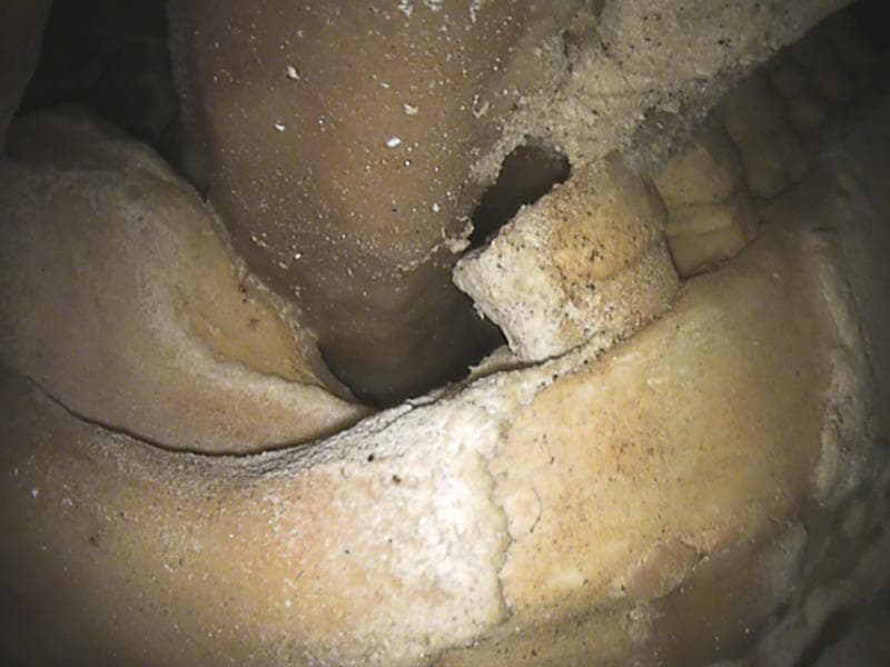 This clinical photograph shows a close-up view of the posterior mandible in an archaeological hominin specimen, specifically the Altamura Neanderthal. The image focuses on the right mandibular ramus and the molar region. A key anatomical feature demonstrated is the retromolar space, a wide gap distal to the third molar (M3) between the tooth and the anterior margin of the ascending ramus. This feature is a distinctive diagnostic trait of the Neanderthal lineage. The bone surfaces and the occlusal surfaces of the teeth are heavily obscured by a thick, beige-colored calcite layer and coralloid speleothem deposits from the cave environment, which mask fine morphological details such as enamel wear patterns and cortical bone texture. The image illustrates the challenges of paleoanthropological clinical imaging and the preservation state of ancient dental anatomy within karstic systems. Educational concepts include human evolution, Neanderthal craniofacial morphology, and the impact of taphonomic processes on skeletal remains.