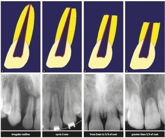 A comparison chart illustrating the Malmgren classification of external inflammatory apical resorption (EIAR), a common complication in orthodontic practice. The educational graphic is divided into four stages (Degrees 1–4), each featuring a schematic anatomical diagram paired with a corresponding periapical radiographic image. Degree 1 shows an irregular outline of the root apex without significant loss of length. Degree 2 depicts minor resorption with root shortening up to 2 mm. Degree 3 shows moderate resorption where the root length is reduced by 2 mm up to one-third of the original length. Degree 4 represents severe resorption with loss exceeding one-third of the root length. The diagrams highlight the exposure of the root canal system as the apex blunts, while the radiographs demonstrate the transition from a pointed apical morphology to a flattened, shortened clinical appearance. This material serves as a diagnostic guide for assessing root health during orthodontic tooth movement.