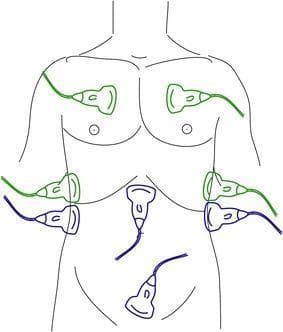 An anatomical diagram illustrating the transducer placement for the FAST (Focused Assessment with Sonography in Trauma) and eFAST (extended FAST) examinations on a human torso. The diagram uses color-coded ultrasound probes to distinguish between protocols. Blue probes indicate the standard FAST positions: the subxiphoid view (pericardial assessment), the right upper quadrant (Morison's pouch/hepatorenal space), the left upper quadrant (splenorenal space), and the suprapubic view (pelvic/rectovesical or recto-uterine pouch assessment) to detect free intraperitoneal fluid. Green probes represent the eFAST extensions: bilateral anterior thoracic views at the second to fourth intercostal spaces and mid-axillary views to assess for pneumothorax and hemothorax. This illustration is an educational tool for emergency medicine, trauma surgery, and radiology, demonstrating the systematic sonographic approach used to identify life-threatening hemorrhage or air in the thoracic and abdominal cavities during the primary survey of trauma patients.