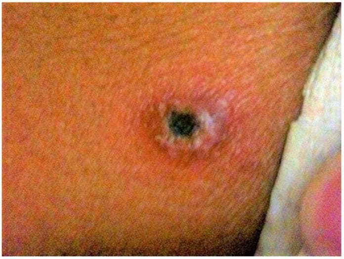 This clinical photograph displays a characteristic eschar on the skin, a pathognomonic sign of scrub typhus (Orientia tsutsugamushi infection). The lesion features a necrotic, centrally depressed black crust (eschar) approximately 0.5 to 1 cm in diameter. Surrounding the dark central necrotic core is a distinct, slightly raised, pale grayish-white rim. This is further encircled by a prominent area of erythema (redness) and mild edema, indicating a localized inflammatory response at the site of the larval mite (chigger) bite. The skin texture within the erythematous zone appears slightly irregular. Such lesions are typically found in areas where skin surfaces are in contact, such as the axilla, groin, or back, and are critical for the early clinical diagnosis of rickettsial diseases when other symptoms like fever, myalgia, and rash are present.