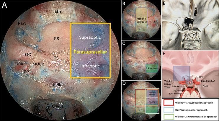 This composite educational graphic illustrates the surgical anatomy and modular corridors of the endoscopic endonasal parasuprasellar approach. Panel A shows an intraoperative endoscopic endonasal view with key landmarks labeled: posterior ethmoidal artery (PEA), planum sphenoidale (PS), optic canal (OC), tuberculum sellae (TS), medial and lateral optocarotid recesses (MOCR, LOCR), carotid protuberance (CP), and the sella. A yellow quadrangle delineates the parasuprasellar area, further divided by the optic nerve into supraoptic and infraoptic regions. Panels B–D provide comparative overlays of different surgical modules: midline (transsellar/transtuberculum), cavernous sinus (CS), and parasuprasellar corridors, coded by color (red, blue, green) to represent various combined surgical approaches. Panel E presents a 3D reconstruction of a postoperative CT scan demonstrating the extent of bone removal. Panel F is a schematic diagram illustrating the neurovascular relationships in the parasuprasellar area, including the optic nerve (CN II), oculomotor nerve (CN III), and supraclinoidal internal carotid artery (ICA). This material is intended for neurosurgical training in skull base surgery and endoscopic corridor selection.