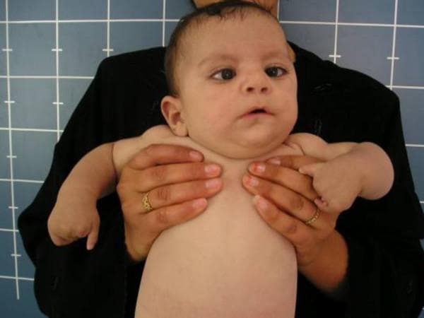 A clinical photograph of an infant displaying dysmorphic features and limb anomalies, characteristic of Moebius syndrome or related orofacial-digital-limb syndromes. The facial features demonstrate bilateral strabismus (suggestive of abducens nerve palsy) and a mask-like, expressionless face (suggestive of facial nerve palsy). Other cranial findings include a prominent forehead, a depressed nasal bridge, and low-set ears. The most striking abnormality is terminal transverse limb deficiency, specifically a subtotal absence of the phalanges. The hands show adactyly/hypoglossia-hypodactyly spectrum characteristics: the central digits are largely absent, while the thumbs and fifth fingers are preserved but hypoplastic. The infant also exhibits a short neck. This image serves as a clinical reference for identifying congenital multiple cranial nerve palsies associated with significant distal limb reduction defects, emphasizing the diagnostic triad of facial paralysis, ocular misalignment, and digital anomalies.