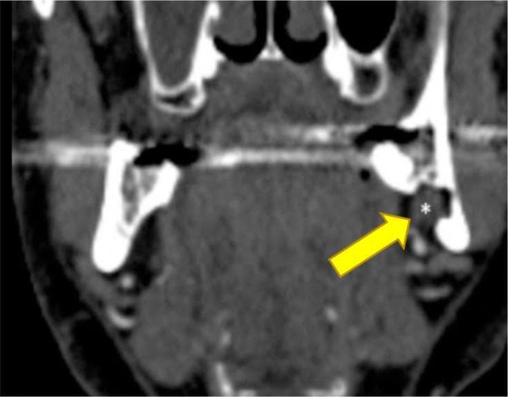 This diagnostic image is a coronal reconstruction from a CT angiogram of the head and neck, focusing on the mandible and submandibular region. The image demonstrates a well-defined Stafne bone cavity (SBC), also known as a static bone cyst or lingual mandibular bone depression. A yellow arrow points to a distinct focal concavity or discontinuity in the lingual cortical plate of the posterior mandible. Within this osseous defect, a white asterisk marks an area of soft tissue density that is continuous with the submandibular gland, confirming the herniation of glandular tissue into the mandibular depression. This finding is a classic anatomical variant rather than a true cyst or pathological lesion. The image is highly relevant for oral and maxillofacial radiology, illustrating how cross-sectional imaging can differentiate incidental radiolucent findings in the mandible from more aggressive odontogenic pathologies by identifying the presence of ectopic salivary gland tissue.