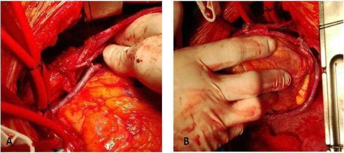This clinical photograph consists of two panels (A and B) demonstrating intraoperative views of Coronary Artery Bypass Grafting (CABG) surgery using the VEST (Venous External Support Technology) system. In Panel A, a saphenous vein graft (SVG) is shown anastomosed to the posterior descending artery (PDA). The graft is encased in a cobalt-chrome mesh external stent, which provides structural support to the vein and is visible as a fine metallic sheath over the vessel. Several red surgical cannulas are visible in the left periphery. In Panel B, the surgeon's gloved hand is shown manipulating the epicardium to expose the ramus intermediate artery, where another stented SVG segment has been anastomosed. The heart's epicardial surface appears yellow due to subepicardial adipose tissue. These images illustrate the surgical application of external stents to saphenous vein grafts, intended to improve graft patency by reducing intimal hyperplasia and wall tension through mechanical stabilization of the conduit's diameter.