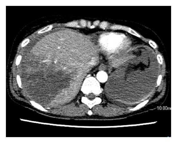 This diagnostic image is an axial contrast-enhanced CT scan of the upper abdomen showing acute traumatic liver injury. The primary finding is a deep, heterogeneous hypodense area within the right hepatic lobe, consistent with a Grade IV liver laceration according to the American Association for the Surgery of Trauma (AAST) Organ Injury Scale. There is notable disruption of the normal hepatic parenchyma architecture. Surrounding the liver and spleen, high-density fluid is visible, indicative of a significant hemoperitoneum (intra-abdominal hemorrhage). Despite the extensive laceration, there is no evidence of active contrast extravasation, pseudoaneurysm, or arterioportal fistula (APF) at this stage. The scan is a critical educational example of blunt abdominal trauma imaging, demonstrating the hallmarks of major solid organ injury and the typical appearance of associated peritoneal free fluid in an emergency radiology context.