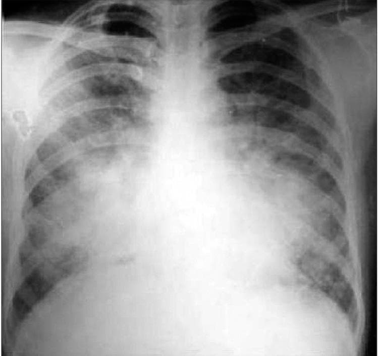 This diagnostic image is a posteroanterior (PA) view chest X-ray demonstrating a bilateral, symmetric alveolar filling pattern. The abnormal opacities are primarily concentrated in the perihilar and mid-lung zones, exhibiting a classic 'bat-wing' or 'butterfly' distribution. These areas show increased density compared to normal aerated lung tissue, while the pulmonary apices and peripheral costophrenic angles appear relatively spared. The cardiac silhouette is of normal size with no signs of cardiomegaly, suggesting a non-cardiogenic etiology for the pulmonary edema or infiltrates. Clinical significance includes the assessment of Acute Respiratory Distress Syndrome (ARDS) or diffuse alveolar hemorrhage, particularly in the context of severe systemic infections like Plasmodium vivax malaria. This image serves as an educational example of bilateral alveolar opacities and the radiographic distinction between cardiogenic and non-cardiogenic pulmonary processes for intermediate to advanced medical learners.