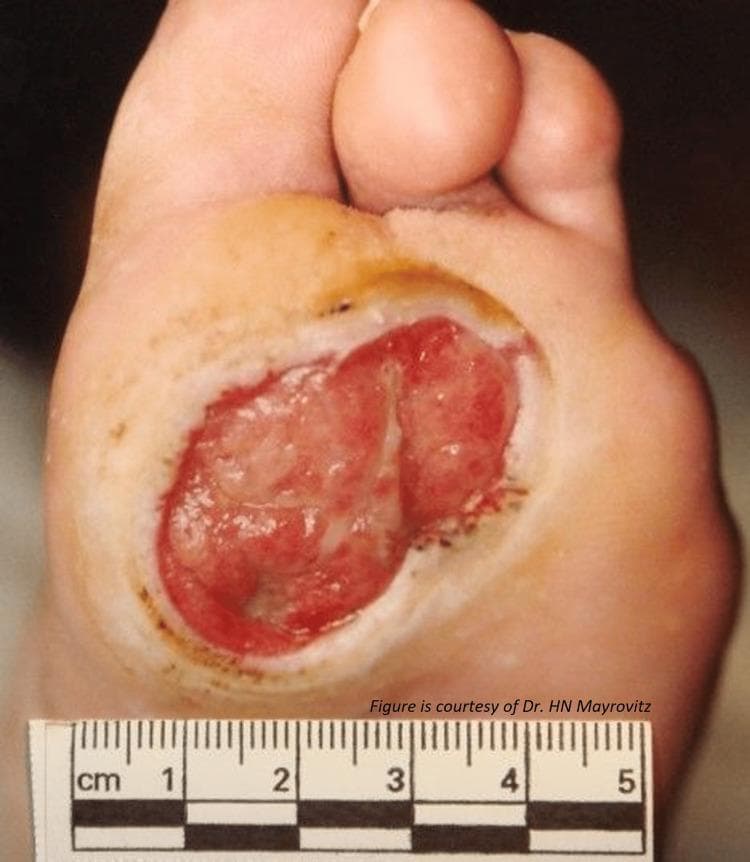 Clinical photograph of a diabetic neuropathic ulcer located on the plantar surface of the foot, specifically over the metatarsal head region. The image displays a large, full-thickness skin lesion measuring approximately 3.5 cm in length and 2.5 cm in width, as indicated by a metric ruler in the foreground. The ulcer bed is characterized by beefy red granulation tissue with a moist, glistening appearance, indicating high vascularity. There is evidence of a hyperkeratotic rim (callus formation) around the irregular, punched-out margins, which is a hallmark of repetitive mechanical stress and neuropathy. The surrounding periwound skin shows mild hyperpigmentation and maceration but lacks significant signs of acute spreading cellulitis. This visual is representative of a Wagner Grade 2 diabetic foot ulcer, serving as a critical educational example for podiatric assessment, wound care management, and the clinical manifestation of diabetic microvascular and neuropathic complications.