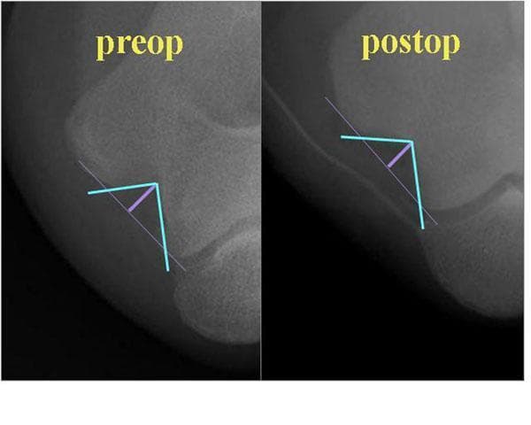 This diagnostic image consists of two side-by-side X-rays of the elbow in a specialized cubital tunnel view (anteroposterior view with full flexion and 20 degrees of external rotation). The radiographs compare pre-operative (preop) and post-operative (postop) anatomy following a minimal medial epicondylectomy and in situ decompression for cubital tunnel syndrome. The images are annotated with cyan lines to measure the Cubital Tunnel Angle (CTA) and a purple line to indicate the Cubital Tunnel Depth (CTD). In the 'preop' image, the CTA is narrower and the CTD is deeper, illustrating the bony constriction that can lead to ulnar nerve irritation. In the 'postop' image, following the partial removal of the medial epicondyle, the cyan lines demonstrate a significantly widened angle and a shallower depth. This comparison serves as an educational tool to visualize the surgical objective of increasing the volume of the cubital tunnel to relieve ulnar nerve entrapment.