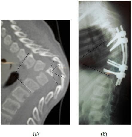 This composite diagnostic image illustrates a case of severe thoracic angular kyphosis and its subsequent surgical management. Image (a) is a sagittal CT scan of the thoracic spine demonstrating the destruction and collapse of four vertebral bodies at the apex of the deformity. Dashed lines highlight the areas of significant bone loss and structural irregularity, resulting in a sharp gibbus deformity. The posterior arches remain visible despite the anterior column collapse. Image (b) is a lateral postoperative radiograph showing a posterior spinal fixation construct spanning from T4 to T11. The instrumentation consists of pedicle screws and longitudinal rods intended to stabilize the segment and provide partial correction. The image shows a residual postoperative kyphosis of 55 degrees. This comparison is characteristic of spinal tuberculosis (Pott's disease) or severe traumatic collapse leading to neurological compromise, specifically demonstrating the transition from a Frankel C paraparesis state to postoperative stabilization.