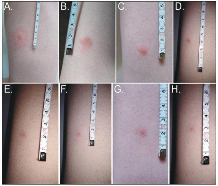 This clinical photographic series (Figures 3A–3H) illustrates the temporal evolution and resolution of a human skin lesion following a bite from the forest fly, Hippobosca equina. The progression is documented over 19 days on the thigh, with a measuring tape providing scale. Initial presentation (19–40 hours) shows painful, urticarial pink papules surrounded by a prominent circular erythematous base approximately 2–3 cm in diameter. By 64 hours (Figure 3C), the lesion transitions to an excoriated erythematous papule with localized dermatitis, reflecting a decrease in surrounding inflammation. The subsequent images (99–260 hours) demonstrate a gradual reduction in size, elevation, and redness. The final stage at 19 days (Figure 3H) reveals a residual hyperpigmented papule, approximately 0.5 cm, marking the resolution of acute inflammation with lingering post-inflammatory hyperpigmentation. This timeline provides a clinical reference for identifying and predicting the natural history of insect-induced dermatological reactions in a human host.
