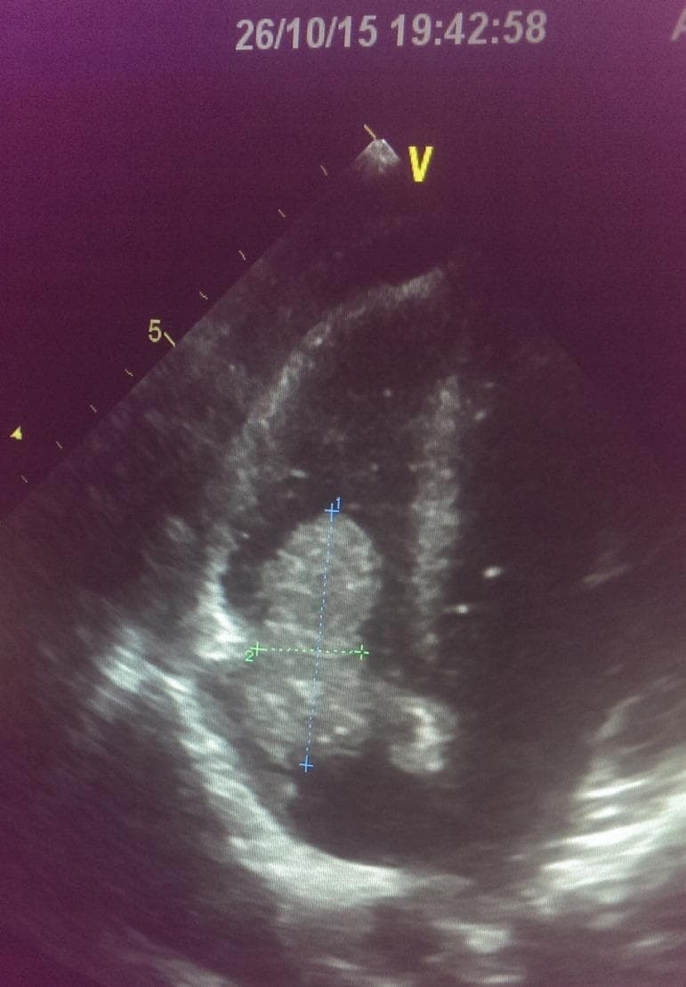 A diagnostic ultrasound (echocardiogram) image depicting a prominent vegetation associated with infective endocarditis. The image shows a large, roughly oval-shaped, echogenic mass situated within a right-sided cardiac chamber. This mass exhibits a heterogeneous internal texture and irregular, well-defined borders. Electronic calipers (marked with '+' and '1' and '2') are seen measuring the longitudinal and transverse dimensions of the structure. The vegetation appears to be attached to the tricuspid valve, where it potentially obstructs normal leaflet excursion or causes valvular regurgitation. This clinical finding is particularly relevant in patients with permanent indwelling vascular access, such as dialysis catheters, which are known risk factors for right-sided infective endocarditis. The image illustrates the typical appearance of valvular vegetation as a mobile, echogenic intracardiac mass, essential for the diagnosis of endocarditis based on the Modified Duke Criteria.