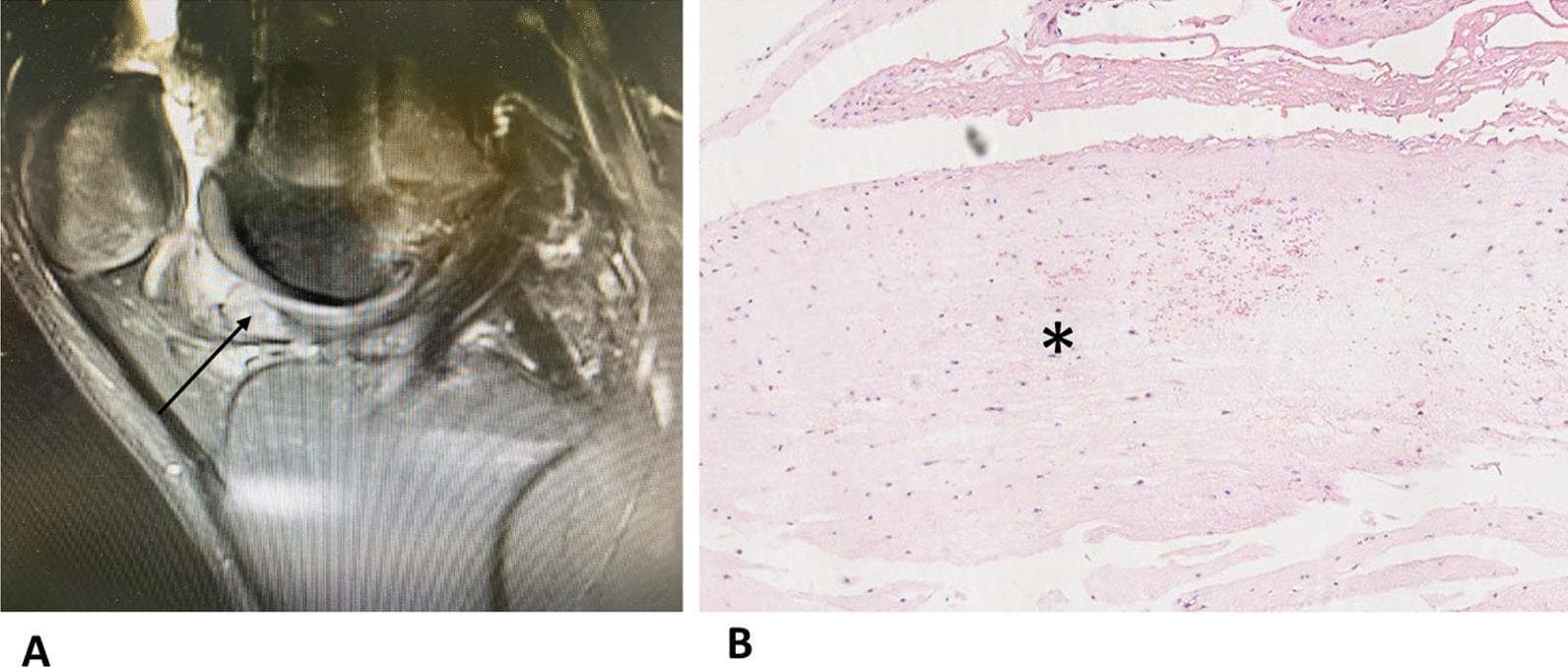 This composite educational figure illustrates the clinical imaging and histopathology of a cyclops lesion (localized arthrofibrosis) following anterior cruciate ligament (ACL) reconstruction. Panel A shows a sagittal T2-weighted or proton density-weighted MRI of the knee. An arrow highlights the pathognomonic cyclops lesion: a well-defined, low-to-intermediate signal intensity nodule situated within the anterior intercondylar notch, anterior to the ACL graft. The lesion demonstrates typical morphology that can cause extension deficit by mechanical impingement. Panel B provides a corresponding histopathological view via light microscopy (H&E stain). The section, marked with an asterisk, shows dense, hypocellular fibrous connective tissue. The tissue exhibits a relatively uniform, wavy collagenous texture with scattered spindle-shaped fibroblasts, closely resembling the organized structure of tendinous or ligamentous tissue. This comparison facilitates the understanding of postoperative complications in orthopedic surgery, specifically the fibroproliferative response of ACL remnants or graft material that leads to symptomatic intra-articular masses.