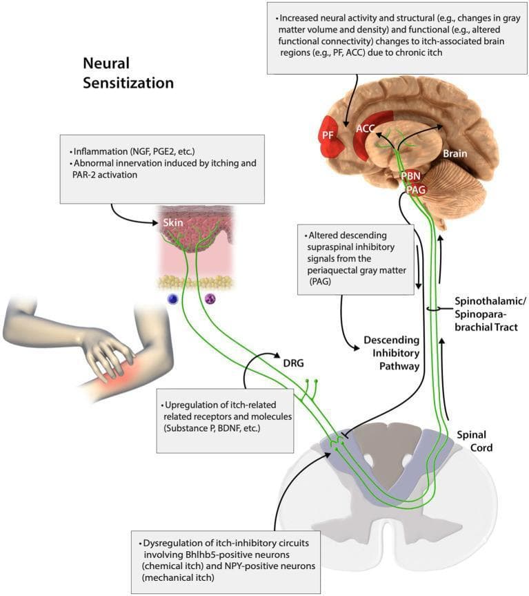 An educational pathophysiology diagram illustrating the pathways of peripheral and central neural sensitization in chronic itch. The diagram traces signals from the skin, through the spinal cord, to the brain. Primary cutaneous stimuli include inflammation (NGF, PGE2) and abnormal innervation via PAR-2 activation. Pruritic signals travel through the dorsal root ganglion (DRG), where upregulation of Substance P and BDNF occurs, and enter the spinal cord. The spinal level highlights dysregulation of itch-inhibitory circuits involving Bhlhb5-positive (chemical itch) and NPY-positive (mechanical itch) neurons. Ascending transmission via the spinothalamic and spinoparabrachial tracts carries signals to the brain, specifically the periaqueductal gray (PAG) and parabrachial nucleus (PBN). The diagram depicts increased neural activity and structural/functional changes (gray matter volume, connectivity) in cortical regions including the prefrontal cortex (PF) and anterior cingulate cortex (ACC). A descending inhibitory pathway from the PAG to the spinal cord is also shown, noting altered supraspinal inhibitory signals that contribute to the chronic itch cycle.