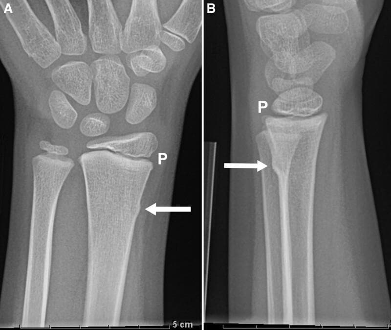 This diagnostic image consists of two X-ray radiographs—posteroanterior (A) and lateral (B) views—of a pediatric wrist belonging to an eight-year-old patient. The images demonstrate a cortical buckle fracture (torus fracture) involving the distal radial metaphysis. In both projections, a white arrow highlights a subtle focal bulging or outward buckling of the bony cortex without frank cortical disruption or angulation. The distal radial physis, labeled 'P', is visible as a clear radiolucent line, indicating the growth plate remains open. A key educational feature is the presence of normal, intact trabecular bone between the fracture site and the physis, distinguishing this as a stable buckle fracture rather than a potentially unstable distal radius fracture or a physeal injury. The carpal bones and distal ulna appear unremarkable. This clinical image is significant in pediatric orthopedics for teaching the morphologic criteria used to differentiate stable cortical deformities from unstable fractures requiring different management protocols.