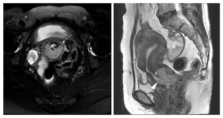 This diagnostic imaging panel consists of two T2-weighted MRI scans of the female pelvis, depicting a stage IB1 cervical adenocarcinoma. The left image is an axial T2-weighted section showing a moderately lobulated mass in the uterine cervix. A white arrow highlights a focal disruption of the low-signal-intensity peripheral fibrous rim, which initially suggested parametrial invasion (MRI stage T2b) but was postoperatively confirmed as pathologic stage T1b1. The right image is a sagittal T2-weighted section used to measure the tumor's maximum longitudinal extent, identified as 3.6 cm. The mass exhibits characteristic intermediate T2 signal intensity compared to the hyperintense cervical mucosa and hypointense stromal ring. This case illustrates the clinical challenge of MRI overstaging in cervical cancer, where stromal disruption can mimic higher-stage disease. The imaging serves as an educational example for gynecologic oncology and radiology in assessing tumor size and local extension during preoperative staging.