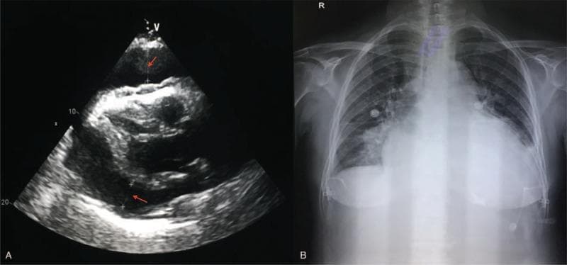 The image consists of two diagnostic panels demonstrating a large pericardial effusion. Panel (A) is an echocardiogram in a parasternal long-axis or similar view showing a significant, dark (anechoic) space surrounding the heart, representing a large pericardial effusion. Red arrows indicate the fluid layer between the epicardium and the parietal pericardium, which causes visible compression of the cardiac chambers. Panel (B) is a posterior-anterior (PA) chest X-ray showing severe cardiomegaly with a 'water-bottle' heart configuration, characterized by a globally enlarged, globular cardiac silhouette with indistinct borders. This radiographic sign is highly suggestive of massive pericardial fluid accumulation. The lungs appear relatively clear, though the bases are obscured by the enlarged cardiac shadow and the diaphragm. The combination of these images serves as a classic educational example of the diagnostic correlation between ultrasound and radiography for pericardial disease.