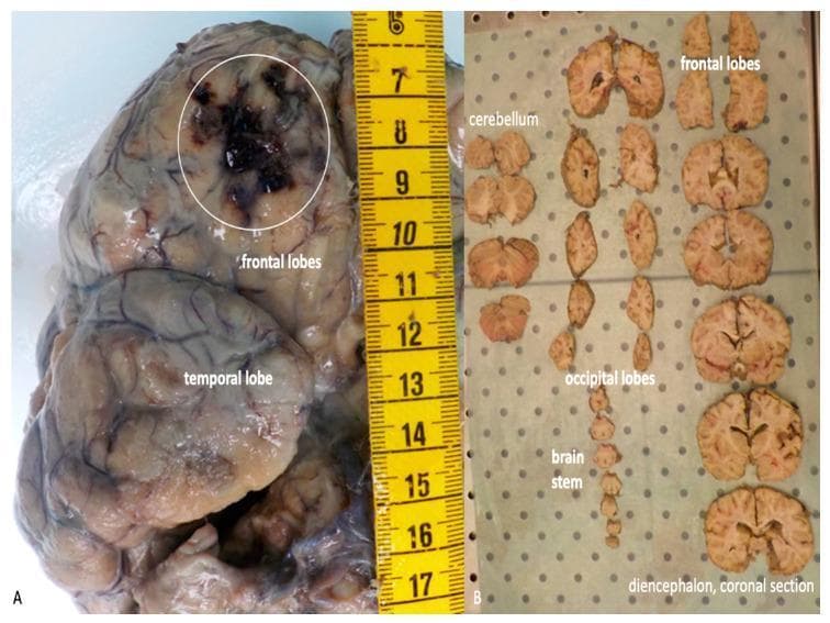 This composite clinical photograph displays a macroscopic examination of a human brain specimen following formalin fixation, illustrating traumatic brain injury (TBI) pathology. Figure A shows the superior and lateral view of the intact brain in toto. A prominent focal traumatic contusion is visible in the right frontal lobe, highlighted by a white circle; the lesion presents as a dark, irregular area of intraparenchymal hemorrhage and necrotic tissue damage. A yellow metric scale is positioned next to the specimen for size reference. Figure B demonstrates the pathological processing of the specimen through serial coronal sections laid out for systematic inspection. Labeled structures include the frontal lobes, cerebellum, occipital lobes, brainstem, and a specific coronal section of the diencephalon. The sections allow for the evaluation of deep cortical structures and internal anatomy, such as the ventricular system and basal ganglia, which is essential in forensic pathology and clinical neurology for correlating localized brain lesions with clinical symptoms or cause of death.