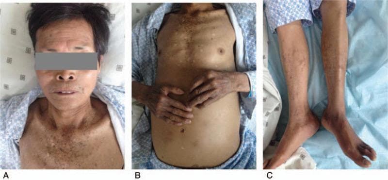 Clinical photographs of a 65-year-old male demonstrating systemic skin hyperpigmentation, a characteristic finding in hereditary hemochromatosis (bronze diabetes). Panel A shows the face and upper chest with a speckled, mottled pattern consisting of numerous small dark macules and patches. Panel B displays the trunk and dorsal surfaces of the hands; the torso exhibits generalized tanning with uneven pigment distribution, and the hands show prominent hyperpigmentation relative to the forearms. Panel C illustrates the lower extremities, where the hyperpigmentation is most pronounced on the distal aspects of the feet and toes, appearing as a dark brownish-purple hue. The legs show a scattered, mottled pigmentary pattern. These visual signs, combined with the patient's history of liver cirrhosis and diabetes, represent the classic 'bronzing' of the skin due to systemic iron overload and increased melanin production. The presentation is medically significant for the diagnosis of secondary or hereditary hemochromatosis involving iron deposition in various organs.