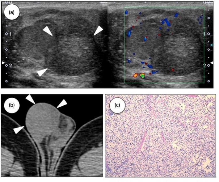 This composite educational image illustrates the multimodal diagnostic features of a testicular seminoma. Panel (a) presents scrotal ultrasound images of the right testicle. The grayscale view reveals a heterogeneous, predominantly hypoechoic intratesticular mass (white arrowheads) measuring approximately 2 cm. The adjacent color Doppler image demonstrates internal vascularity within the lesion. Panel (b) shows a computed tomography (CT) scan of the scrotum in the axial plane, identifying a well-circumscribed, slightly heterogeneous mass within the testicle (arrowheads). Panel (c) is a histopathological micrograph using Hematoxylin and Eosin (H&E) staining. It depicts the classic architectural and cellular characteristics of a pure seminoma, featuring a uniform population of large, polygonal cells with clear cytoplasm and distinct cell borders. These tumor cells are organized into nests or lobules separated by thin fibrous septa, which contain a characteristic lymphocytic infiltrate. This sequence demonstrates the clinical progression from initial radiological detection via ultrasound and CT to definitive pathological diagnosis through biopsy, highlighting key features of germ cell tumors in the urological specialty.