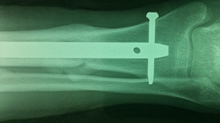 This diagnostic radiograph (X-ray) displays a consolidated spiral fracture of the distal fourth of the tibia and fibula. The tibial fracture, classified as AO/OTA type A1-1, shows significant interval healing with exuberant periosteal callus formation bridging the original fracture site. Alignment is well-maintained with the restoration of the anatomical axis. Internal fixation is demonstrated by a radiopaque intramedullary nail positioned within the tibial canal. A single distal interlocking screw is visible, transfixing the distal tibia and the nail to provide rotational and axial stability. The fibular fracture is also visible in the background with signs of secondary bone healing. The ankle joint space and mortise appear preserved. This image serves as a clinical example of successful surgical management of a distal leg fracture using antegrade intramedullary nailing, emphasizing bone union and alignment preservation in orthopedic trauma.