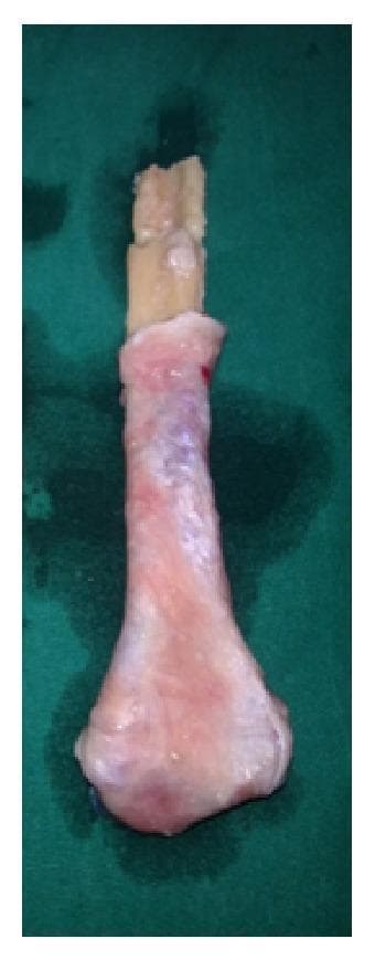 A clinical photograph of an autologous surgical specimen: a prepared free fibular graft intended for proximal ulnar reconstruction. The graft consists of a harvested segment of the upper fibula. The proximal end of the fibular bone shaft is visible as a yellowish-white, rectangular cortical bone segment. The distal portion, representing the fibular head, has been surgically shaped to mimic the anatomical contour of the olecranon process. This head is entirely enveloped in a soft tissue layer, likely consisting of harvested tensor fascia lata, which has been secured to the bone to serve as a biological articular surface. The soft tissue appears pinkish-red and translucent with minimal blood spotting. This composite graft is used in orthopedic oncology or trauma surgery to restore joint function and structural integrity following the excision of bone tumors, such as a giant cell tumor of the proximal ulna.