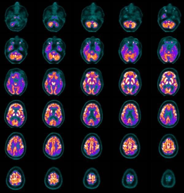 This diagnostic image set consists of 30 transversal slices from an FDG-PET (Fluorodeoxyglucose Positron Emission Tomography) scan of a patient with Alzheimer's disease. The color-coded metabolic map uses orange/red to represent high glucose metabolism and purple/blue for low metabolism (hypometabolism). The scans demonstrate a classic neurodegenerative pattern: marked hypometabolism is visible in the posterior cingulate cortex and the posterior temporoparietal association cortex. In contrast, the frontal lobes and primary motor/sensory cortices show relatively preserved metabolic activity, indicated by the higher intensity orange regions. This visual disparity between the hypoactive posterior regions and the normally active frontal regions is a key diagnostic hallmark used to differentiate Alzheimer's disease from other forms of dementia, such as frontotemporal dementia. The series provides a comprehensive view of global cerebral glucose utilization from the base of the brain through the vertex.
