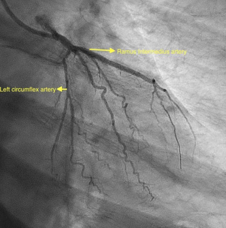 This diagnostic image is a coronary angiogram captured in the right anterior oblique (RAO) caudal projection, providing a specific view of the left coronary system. The image features the left circumflex (LCx) artery and a prominent ramus intermedius (RI) artery, both clearly labeled with yellow arrows. A key educational finding in this image is the absence of the left anterior descending (LAD) artery from its typical anatomical origin at the left main bifurcation, indicating a congenital coronary artery anomaly. The image demonstrates the vessels post-percutaneous coronary intervention (PCI), where the RI artery appears patent following the placement of a drug-eluting stent to treat in-stent thrombosis. This visual material is highly relevant for cardiology training in identifying anomalous coronary origins and understanding the nuances of coronary anatomy during invasive catheterization. The anatomical variants shown illustrate how the ramus intermedius can supply territory typically served by other major branches when anomalies are present.