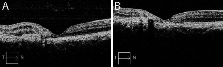 Spectral-domain optical coherence tomography (SD-OCT) cross-sectional images of the retina showing macular progression and treatment response. Image A (baseline) demonstrates a loss of the normal foveal contour with central macular thickening. Key features include intraretinal hyporeflective cystic spaces and subretinal fluid, accompanied by a prominent area of subretinal hyperreflective material (SHRM) suggesting a neovascular membrane. Image B (post-therapy) shows a marked longitudinal improvement after two years. There is a restoration of the foveal depression and a significant reduction in both intraretinal and subretinal fluid. The retinal layers appear more organized and homogeneous, although some residual thinning or architectural changes remain. This comparison illustrates the clinical management of macular telangiectasia type 2 (MT2) complicated by choroidal neovascularization, emphasizing the role of OCT in monitoring exudative changes and therapeutic efficacy of anti-VEGF treatment.