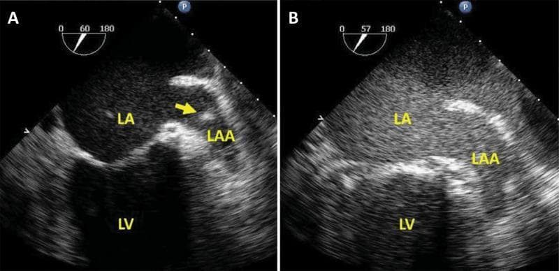 This diagnostic comparison demonstrates the utility of Ultrasound Enhancing Agents (UEA) in transesophageal echocardiography (TEE) for evaluating the left atrial appendage (LAA). Two mid-esophageal views are shown: (A) a non-enhanced baseline image and (B) a contrast-enhanced image. Labels indicate the Left Atrium (LA), Left Atrial Appendage (LAA), and Left Ventricle (LV). In panel A, the LAA contains a distinct hyperechoic signal (yellow arrow) alongside spontaneous echo contrast (known as 'smoke'), which can mimic or mask a thrombus. In panel B, following the administration of a microbubble-based intravenous enhancing agent, the LAA cavity is uniformly opacified. The absence of a filling defect in the contrast-enhanced view effectively rules out an intracavitary thrombus, clarifying that the initial findings were artifacts or stasis. This imaging technique is clinically significant for ensuring procedural safety prior to atrial fibrillation cardioversion, as it provides a higher diagnostic confidence level for excluding embolic sources compared to standard non-contrast 2D echocardiography.