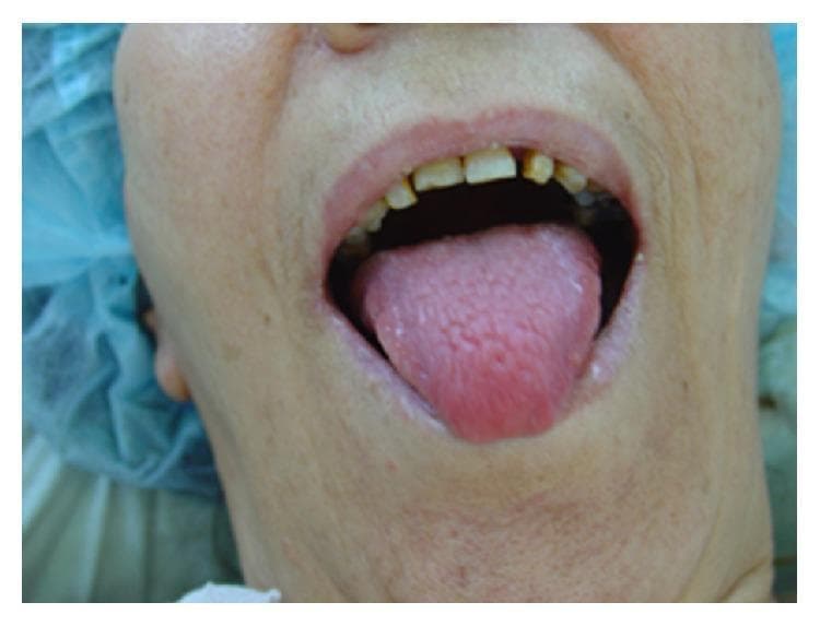 Clinical photograph of the oral cavity showcasing glossitis. The tongue is prominently displayed, appearing bright red (erythematous) and moderately enlarged. The dorsal surface shows signs of atrophy, with a smoother-than-normal texture and partial loss of the standard lingual papillae architecture. In the background, the maxillary teeth exhibit signs of dental attrition and discoloration, and the gingiva appears pale. This presentation is characteristic of nutritional deficiencies or systemic syndromes such as glucagonoma (associated with necrolytic migratory erythema). The image serves as a clinical reference for identifying atrophic glossitis during a physical examination of the head and neck. It is intended for medical students and clinicians to recognize oral manifestations of systemic disease.