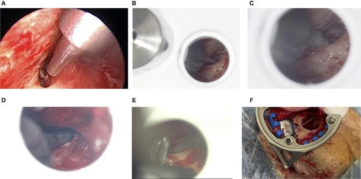 This composite of clinical and diagnostic images demonstrates the intraoperative validation of a minimally invasive cochlear implant (CI) surgical technique using a mini-stereotactic frame and patient-specific jigs. (A-E) Endoscopic and microscopic views of the facial recess (posterior tympanotomy) in multiple patients. The images show various sizes of sham drill bits (1.5 mm and 1.8 mm) being passed through the surgically exposed facial recess to evaluate the accuracy of a planned robotic trajectory. The surgical site displays anatomical landmarks including the facial nerve (FN) canal, chorda tympani, and the thinned external auditory canal (EAC). (F) A clinical photograph showing a titanium C-shaped mini-stereotactic frame fixated to a patient's skull posterior to the ear. The frame is secured via bone screws and holds a blue patient-specific positioning jig with fasteners. This assembly guides the drill path relative to the mastoidectomy site. The educational focus is on robotic-assisted otologic surgery, stereotactic navigation, and the spatial constraints of the facial recess during CI electrode insertion.