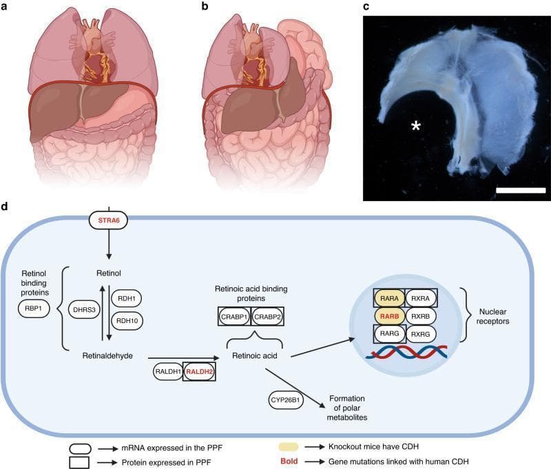 This composite educational graphic illustrates the pathogenesis of Congenital Diaphragmatic Hernia (CDH) and the role of Retinoic Acid (RA) signaling. Panel (a) is an anatomical diagram showing a normal torso with an intact diaphragm separating the thoracic cavity (lungs, heart) from the abdominal cavity (liver, stomach, intestines). Panel (b) depicts CDH, where a diaphragmatic defect allows abdominal viscera to herniate into the chest, causing lung compression and mediastinal shift. Panel (c) is a clinical photograph of a dissected mouse fetal diaphragm (superior view) following teratogen exposure; an asterisk identifies a large, left-sided posterolateral (Bochdalek) defect. Panel (d) is a pathophysiology flowchart of the RA signaling pathway within the pleuroperitoneal fold (PPF). It details biochemical transitions from Retinol to Retinaldehyde and Retinoic Acid, mediated by enzymes like RDH10 and RALDH2. The diagram highlights key molecular components (STRA6, RARB, RXRA) where mutations or knockouts are linked to human CDH or rodent models, illustrating how disrupted gene expression in the PPF leads to structural diaphragmatic failure.