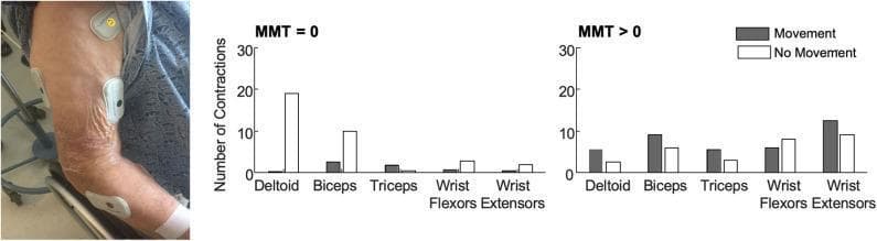 This composite image consists of a clinical photograph and a data visualization chart focused on electromyography (EMG) monitoring in stroke rehabilitation. The clinical photograph on the left shows the paretic arm of a patient with several wireless BioStamp sensors attached to monitor muscle activity. Sensors are visible over the deltoid, biceps, triceps, wrist flexors, and wrist extensors. The skin exhibits signs of atrophy and wrinkling, common in acute stroke or geriatric populations. The right side contains two bar graphs comparing the median number of muscle contractions per 30 minutes in patients with a Manual Muscle Test (MMT) score of 0 (flaccid paralysis) versus those with MMT > 0. The graphs categorize contractions based on whether they occurred during 'Movement' (grey bars) or 'No Movement' (white bars). In the MMT = 0 group, proximal muscles like the deltoid show the highest frequency of contractions without movement. In the MMT > 0 group, contractions are more evenly distributed across all muscle groups, with a higher prevalence during active movement. This educational resource illustrates the utility of surface EMG in detecting subclinical muscle activity for prognostic assessment during neurological recovery.