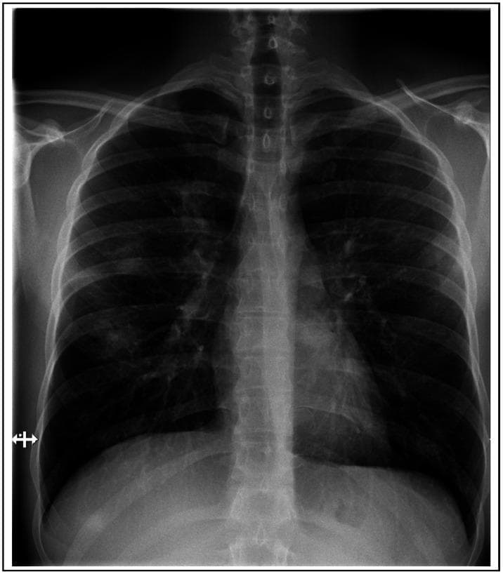 This diagnostic image is a posteroanterior (PA) chest X-ray illustrating the thoracic cavity of a patient with respiratory symptoms. The primary clinical finding is the presence of multifocal, patchy pulmonary infiltrates distributed bilaterally throughout both the left and right lung fields. These areas of increased opacity appear irregular in morphology and are scattered across the lung parenchyma rather than being localized to a single lobe. The cardiac silhouette, mediastinal contours, and diaphragmatic surfaces appear within normal limits. The costophrenic angles are clear, suggesting no significant pleural effusion. This radiographic presentation is consistent with diffuse parenchymal lung involvement, such as that seen in certain infectious processes, tropical eosinophilia, or inflammatory responses. It serves as a classic educational example for identifying non-specific pulmonary infiltrates on plain film radiography, highlighting the importance of correlating imaging findings with clinical history and laboratory data such as peripheral eosinophilia.