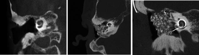 This set of diagnostic images features coronal Cone-Beam Computed Tomography (CBCT) scans of the human petrous bone, comparing preoperative and postoperative states for cochlear implantation. The baseline image shows the native anatomy of the inner ear, including the spiral architecture of the cochlea and the surrounding temporal bone density. The postoperative images demonstrate the successful placement of a cochlear implant. A highly radio-opaque, coiled electrode array is clearly visible within the cochlear lumen, following the scalar tympani curve to stimulate the auditory nerve. Additionally, the surgical field shows evidence of mastoid cavity modification and the presence of filling materials (such as Bonalive or abdominal fat) used for site obliteration. These images serve as a clinical example of using intraoperative or immediate postoperative imaging to verify electrode positioning and surgical outcomes in patients with complex or altered temporal bone anatomy, facilitating high-resolution assessment of the relationship between the hardware and inner ear microstructures.