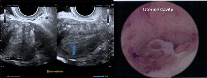 A multi-panel medical image featuring diagnostic imaging of the uterus in a 52-year-old postmenopausal patient. The left panel shows grayscale transvaginal ultrasound (TVUS) images of the uterus in a longitudinal plane. The endometrium is clearly identified, appearing thickened with a heterogeneous echotexture. Electronic calipers indicate an endometrial thickness measurement of 1.14 cm (11.4 mm). A blue arrow highlights a focal hypoechoic area within the thickened endometrial stripe, suggestive of a potential polyp or cystic change. The right panel displays a hysteroscopic view of the uterine cavity. The endoscopic perspective shows a pink, vascular endometrial lining with a prominent, irregular, white-to-tan protruding structure, characteristic of an endometrial polyp. These combined imaging modalities illustrate the evaluation of postmenopausal bleeding and endometrial thickening, which in this clinical case was histologically confirmed as a benign active endometrium.