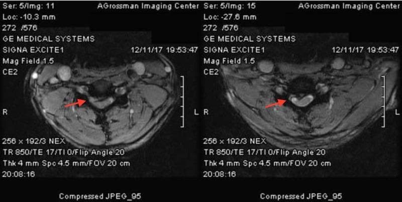 Diagnostic axial MRI images of the cervical spine illustrating varying degrees of intervertebral disc pathology and resulting spinal canal stenosis. The left image demonstrates a 5 mm right paracentral disc herniation that extends toward the neural foramen, causing moderate encroachment. The right image shows a more severe right paracentral disc extrusion, marked by a focal mass effect that significantly compresses and displaces the right anterior aspect of the spinal cord, resulting in visible cord deformity. Both images highlight the spatial relationship between the herniated disc material (indicated by red arrows) and the hyperintense cerebrospinal fluid surrounding the spinal cord. These findings are clinically significant for diagnosing cervical radiculopathy and myelopathy, typically associated with degenerative disc disease. The images serve as an educational comparison between simple herniation and more aggressive extrusion causing mechanical cord compression.