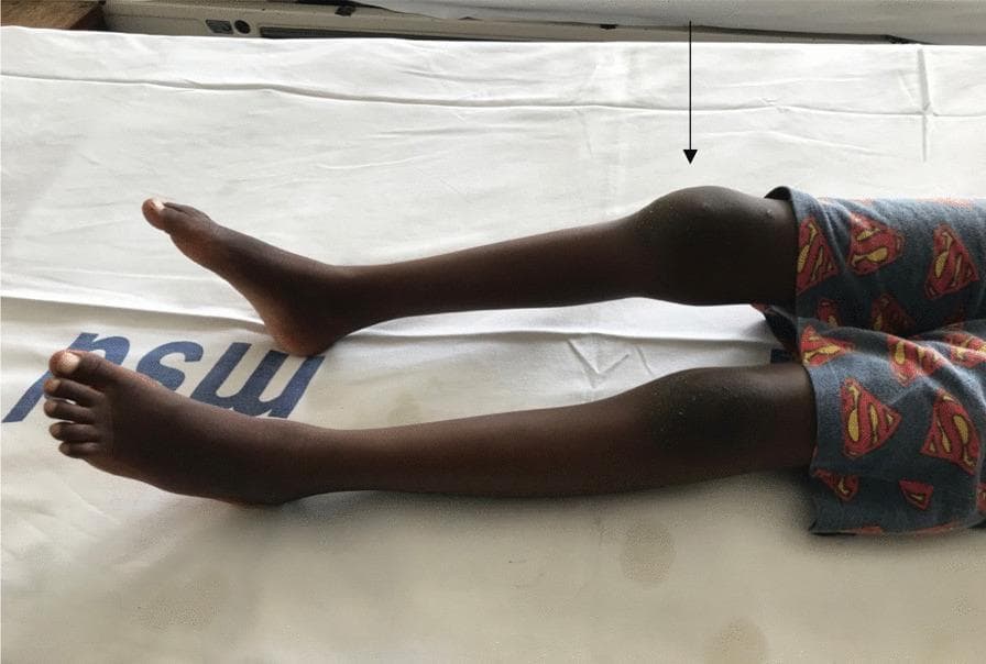 This clinical photograph displays a pediatric patient's lower extremities in a supine position, highlighting significant joint pathology. The primary finding is marked, asymmetrical swelling of the right knee joint compared to the relatively normal contralateral left knee. A black arrow indicates the site of localized joint effusion or soft tissue swelling, which manifests as a prominent, rounded protrusion that distorts the anatomical contour of the patellar and suprapatellar regions. The skin overlying the swelling appears intact without obvious erythema, though the distension is substantial. In the clinical context of a coagulopathy, such as Factor VII deficiency, this visual presentation is highly suggestive of hemarthrosis. Both legs are extended, and no deformities of the feet are visible. This image serves as a teaching aid for identifying joint swelling and understanding the physical manifestations of bleeding disorders in a musculoskeletal examination.
