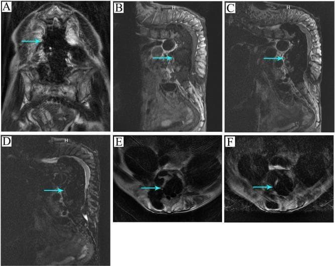 A multi-panel MRI compilation demonstrating spinal tuberculosis with a large calcified abscess. (A) T1-weighted coronal view showing a hypointense lesion. (B) T1-weighted sagittal view and (C) T2-weighted sagittal view highlight severe kyphotic deformity of the spine with a prevertebral and paraspinal abscess (arrows). (D) T2-weighted fat-suppressed sagittal sequence (STIR/lipid pressing) enhances the visibility of the inflammatory process and fluid components. (E) Axial T2-weighted fat-suppressed and (F) standard T2-weighted axial sections demonstrate the circumferential extent of the abscess and its spatial relationship to the spinal canal and collapsed vertebral bodies. The calcified nature of the abscess is indicated by heterogeneous, primarily low-signal regions within the collection across all sequences. This imaging series illustrates the typical presentation of Pott's disease, including vertebral destruction, severe angulation (kyphosis), and chronic cold abscess formation with secondary calcification.