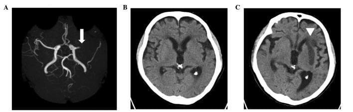 A composite clinical imaging series illustrating the progression of an acute ischemic stroke. Panel A is a Brain Magnetic Resonance Angiography (MRA) showing a high-signal representation of the Circle of Willis; a white arrow indicates an abrupt cutoff and signal loss in the left middle cerebral artery (MCA), consistent with an acute occlusion. Panel B is a non-contrast axial computed tomography (CT) scan of the brain performed on the day of the stroke, showing normal parenchymal attenuation and no acute hemorrhage or visible early ischemic changes. Panel C shows a follow-up axial non-contrast CT scan of the same patient taken six days later; a white arrowhead highlights a well-demarcated area of hypodensity (low attenuation) in the left frontal lobe and basal ganglia, indicating a mature infarction in the vascular territory of the previously identified MCA occlusion. The series highlights the diagnostic utility of vascular imaging in early stroke detection and the temporal evolution of cerebral tissue infarction on CT imaging.