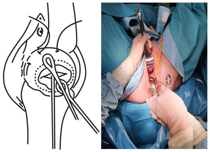 This composite image illustrates the reduction of prolapsed fetal membranes during an emergency cervical cerclage procedure, featuring a side-by-side clinical photograph and schematic diagram. The right panel is a clinical photograph showing the vaginal surgical field draped in blue sterile sheets. A surgeon's gloved hands are seen utilizing a metallic vaginal retractor and surgical forceps to expose the cervix. A yellow Foley catheter is inserted through the cervical canal, utilized here to manually reduce the bulging amniotic sac (membranes) back into the uterine cavity. The left panel provides a corresponding schematic illustration of the female pelvic anatomy, specifically detailing the cervix, uterus, and the placement of surgical instruments. The diagram highlights the mechanical process of using a catheter balloon and purse-string sutures to stabilize the prolapse and secure the cervical os. This educational material is designed for obstetrics and gynecology training, specifically focused on surgical management of cervical insufficiency and fetal membrane prolapse.