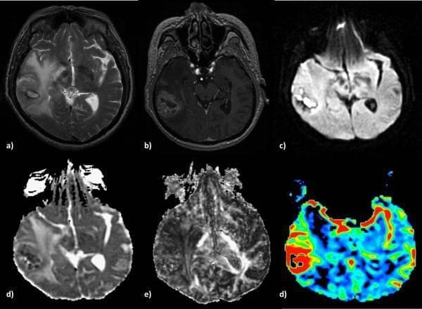 Multi-parametric MRI sequence of a 71-year-old male brain demonstrating an Anaplastic Astrocytoma. (a) Axial T2-weighted image shows a large, hyperintense lesion in the right hemisphere with significant peritumoral vasogenic edema. (b) Post-contrast 3D-SPGR image reveals a mass with heterogeneous, non-uniform contrast enhancement, suggesting variable blood-brain barrier disruption. (c) Diffusion-weighted imaging (DWI) shows high signal intensity in the solid tumor portion, which corresponds to hypointensity on the Apparent Diffusion Coefficient (ADC) map (d), indicating restricted diffusion and high cellularity. (e) Fractional Anisotropy (FA) map displays low values within the lesion, reflecting loss of white matter structural integrity. (f) Relative Cerebral Blood Volume (rCBV) perfusion map shows increased regional blood flow (red areas) indicating tumor neoangiogenesis. This series illustrates the diagnostic imaging features of a Grade III high-grade glioma, emphasizing the use of advanced physiological MRI for tumor grading.